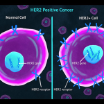 Her2 pozitif İleri evre meme kanserinin güncel tedavisi ? Akıllı ilaç kemoterapi beraber uygulanır mı? Akıllı füze - hedefe atılan füze tedavisi nelerdelir ?