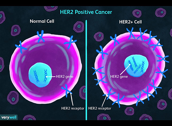 Her2 pozitif İleri evre meme kanserinin güncel tedavisi ? Akıllı ilaç kemoterapi beraber uygulanır mı? Akıllı füze - hedefe atılan füze tedavisi nelerdelir ?